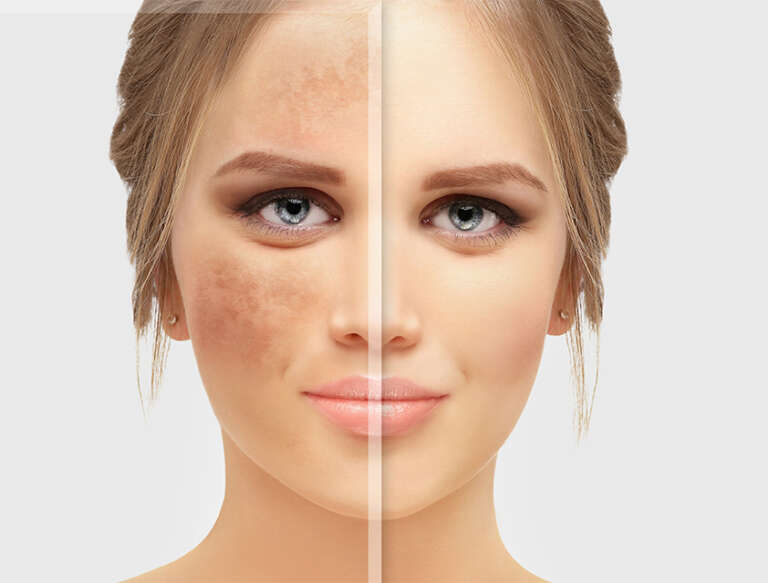 Brown Spot Removal Mclean VA & Woodbridge, VA Skin & Laser