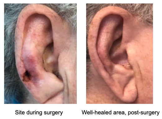 Basal cell carcinoma on the ear