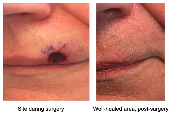 Basal cell carcinoma on the lip